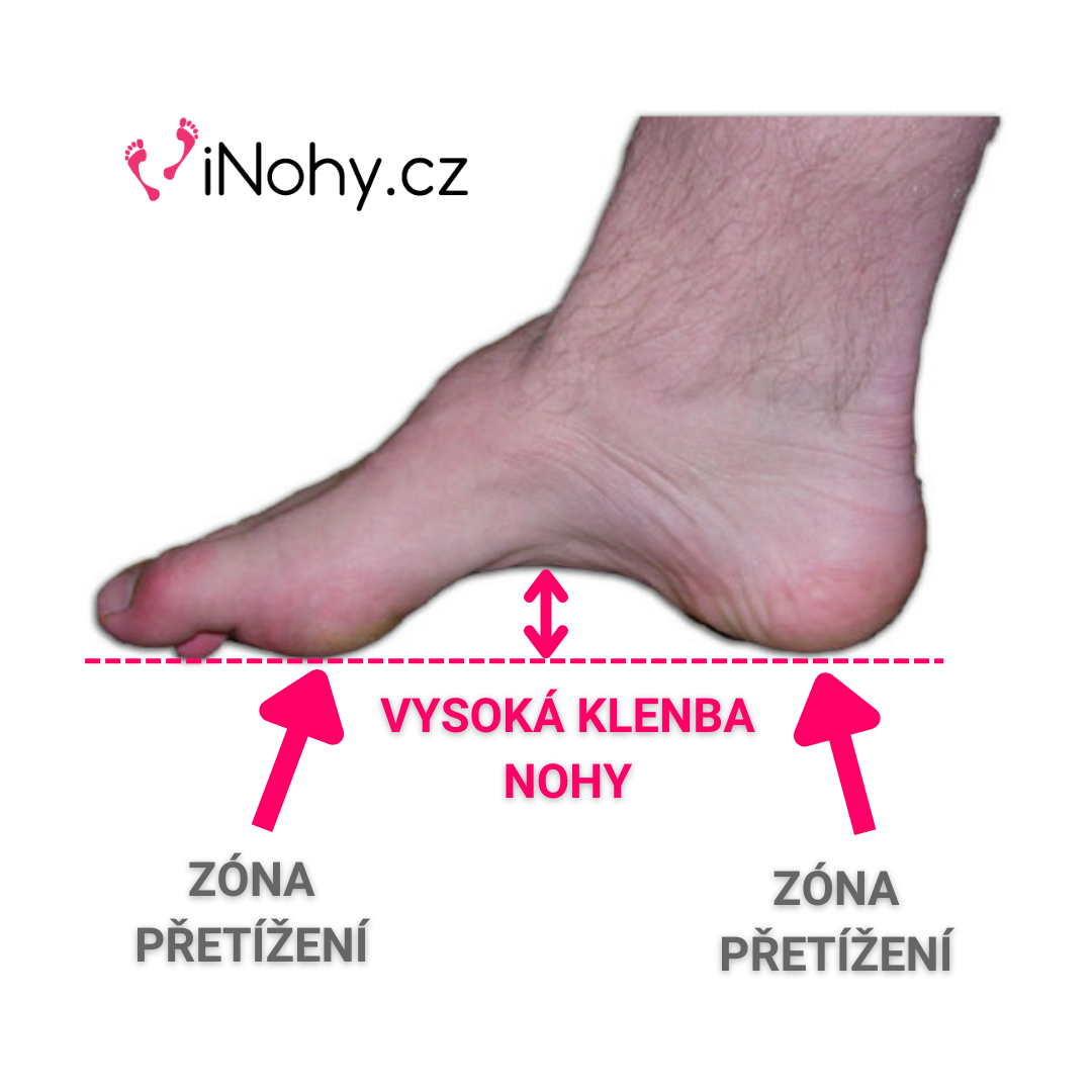 Diagnostika vysoké klenby na noze